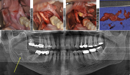 <p>What is required for diagnosis of odontogenic keratocyst?</p>
