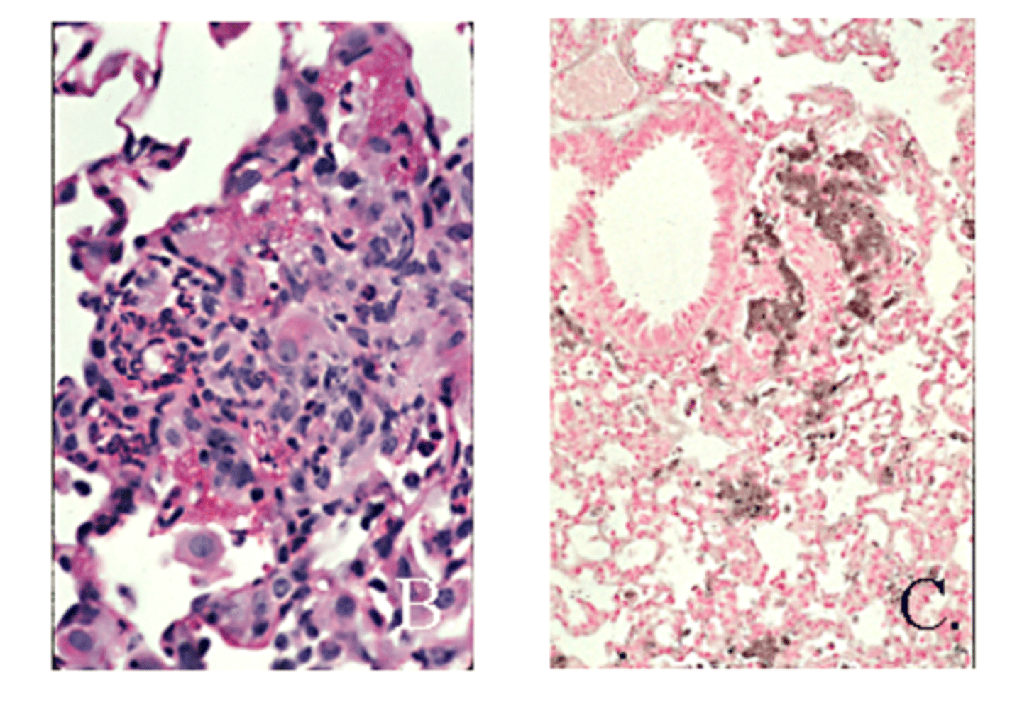 <p>Histolopathololgy on the lungs of a mouse is returned with interstitial alveolitis with thickening of alveolar septa from proteinaceous exudate. What is the likely cause?</p>
