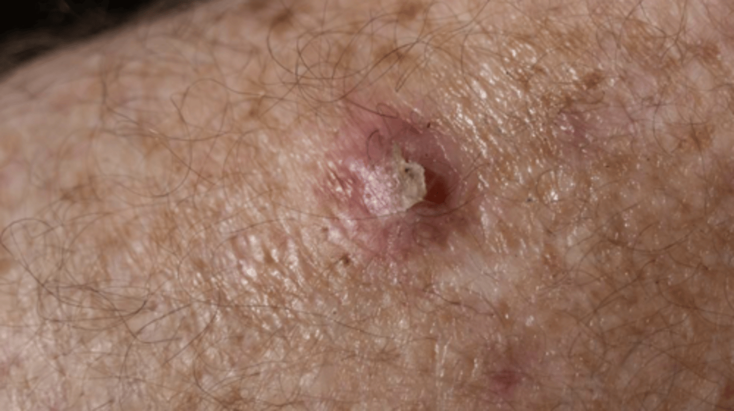 <p>- keratinised, scaly, irregular nodules. On occasion, the keratin may be so developed that it forms a horn or a plug</p><p>- Often in sun exposed areas. There may be background sun-damage, for example wrinkled skin and actinic keratoses.</p><p>- slow growing, over months</p><p>- Pain, tenderness, and bleeding usually present</p>