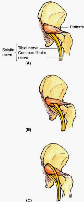 <ul><li><p>Sciatic nerve can become irritated or <strong><em><u>compressed by the piriformis </u></em></strong>muscle → pain and/or paresthesia in the <strong><em><u>gluteal region and posterior thigh</u></em></strong></p></li></ul><p></p><p></p><ul><li><p>An <strong>early division of the sciatic n.</strong> occurs in about 12% of the population and may predispose a person to this condition<br></p></li><li><p>Hypertrophy of the piriformis plays a role as well</p><ul><li><p><u>Dancers, ice skaters, cyclists, etc.</u></p></li></ul></li></ul><p></p>