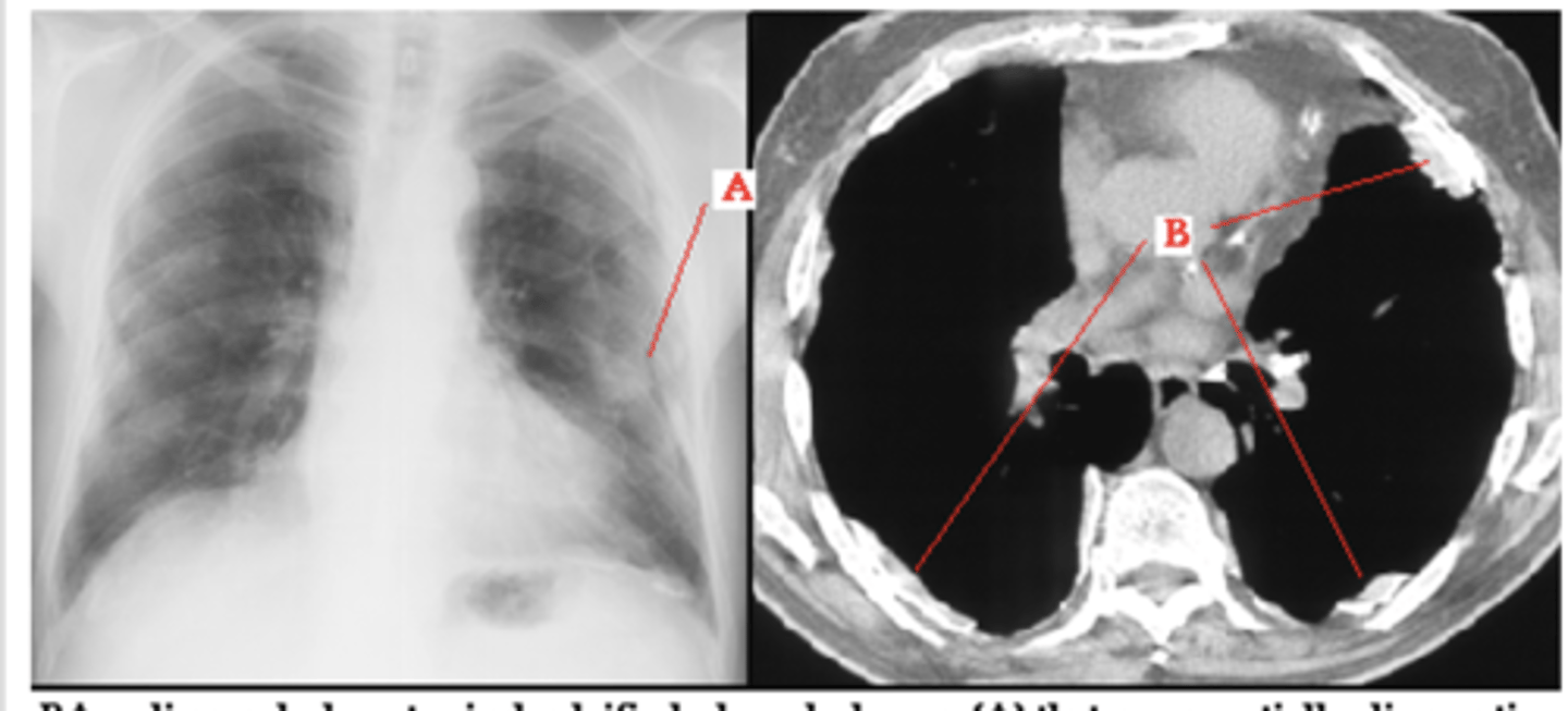 <p>Dx - what is the most common cause of this finding? Bilateral or unilateral?</p>