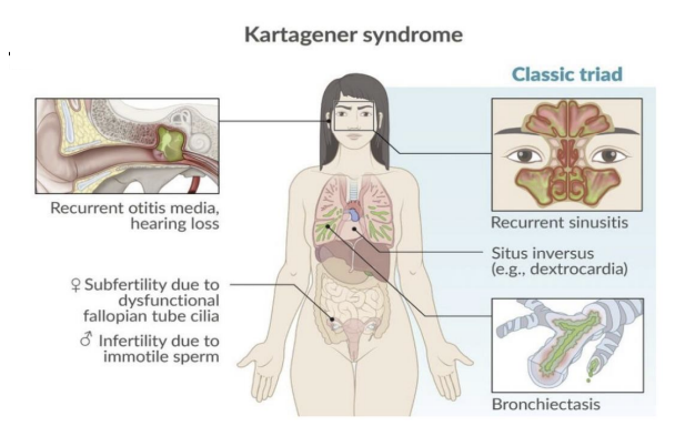 <p>Defects in Axonemal Dynein = Primary Ciliary Dyskinesia or Kartagener’s syndrome. </p><p>Situs Inversus = asymmetry of internal organs. </p><p></p><p>Patients are prone to lung infections and lack of sperm motility = sterile.</p>