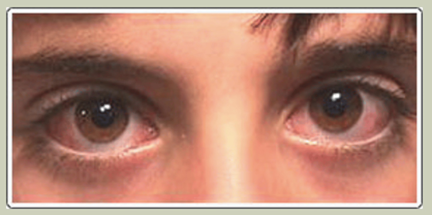 <p>-Bilateral presentation, IgE mediated by allergens</p><p>-SX: itching, tearing, redness</p><p>-Signs: bilateral red eyes with watery discharge, may have mild chemosis</p><p>-Worse in Spring/Summer</p><p>-TX Cold compress, mast cell stabilizer/Antihistamines; refer to ECP</p>