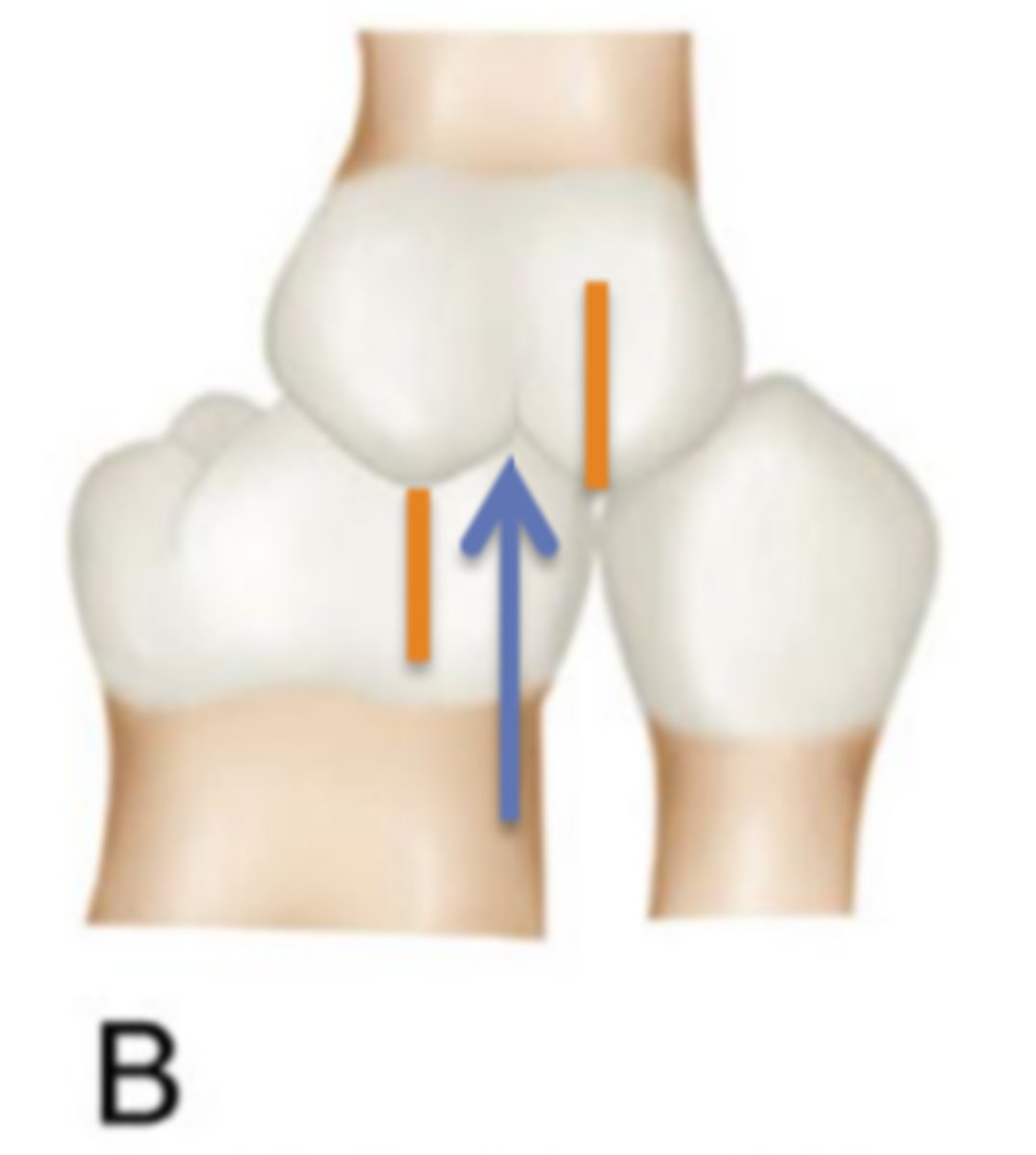 <p>B) class II</p>