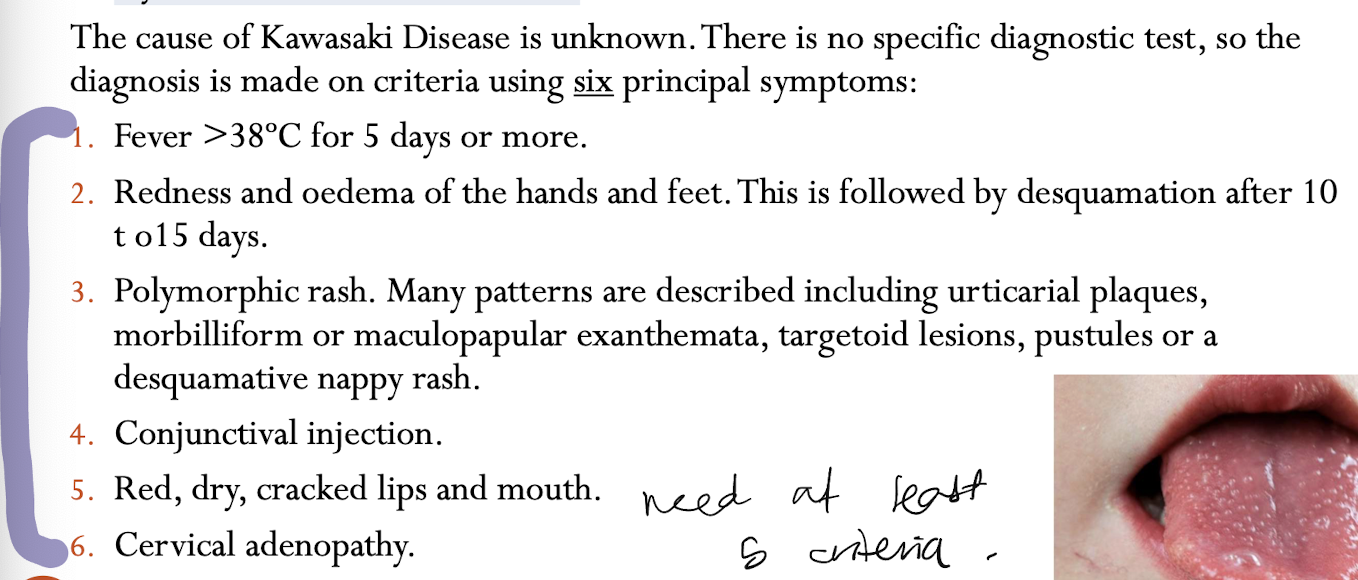 need at least 5 criteria to be diagnosed as hving KD , however 4 criteria in presence of coronary aneurysm is also diagnostic 