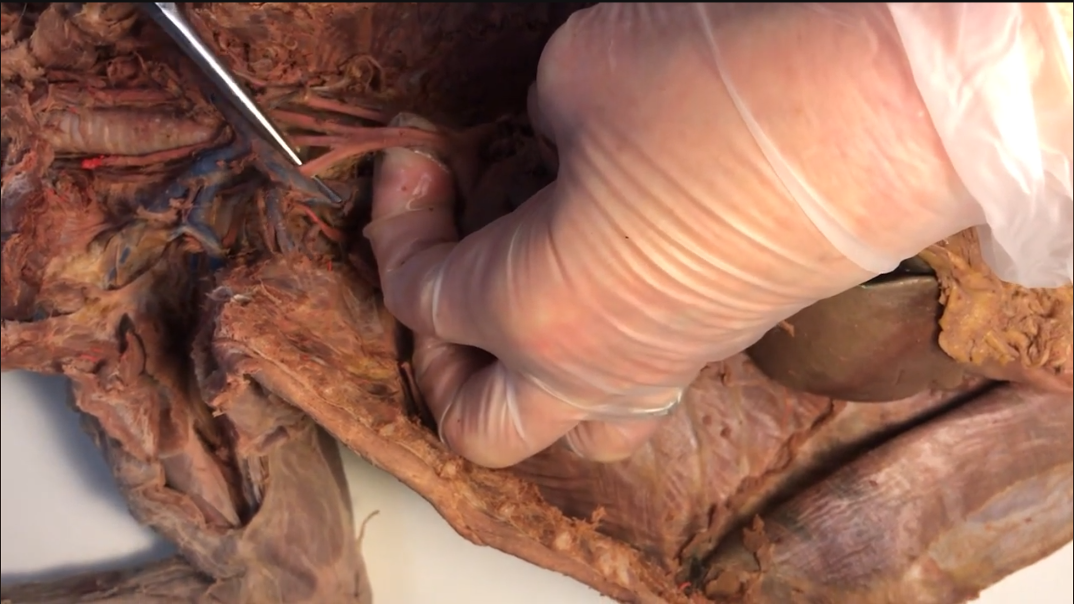 <p>What artery is this</p>