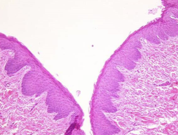 <ul><li><p>Thick, multilayered sheet.</p></li><li><p>Bottom = plump cells, top = flat squamous cells.</p></li><li><p>Looks like a “layer cake,” with the top layer being thin and flat.</p></li></ul><p></p>