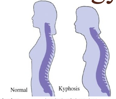 <p><strong>Kyphosis</strong> = increased <strong>outward/backward</strong> curvature of the spine in the <strong>sagittal plane</strong>.<br>Common description: <strong>hunchback</strong>.</p>