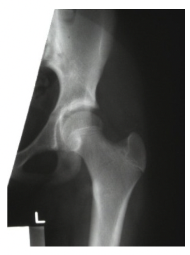 <p>What should the radiographer do to correct this image?</p><p>a. <span>No correction needed</span></p><p>b. <span>Increase internal rotation</span></p><p>c. <span>Increase external rotation</span></p><p>d. <span>Roll patient slightly to left side</span></p>