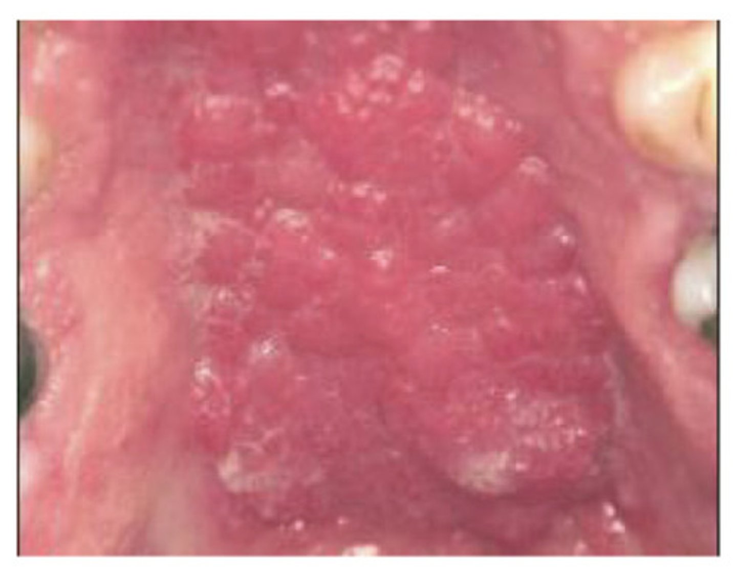 <p>Multipul small nodules with various inflammation, usually in the palate vault - treatment to stop the infection or irritation - what am i?</p>