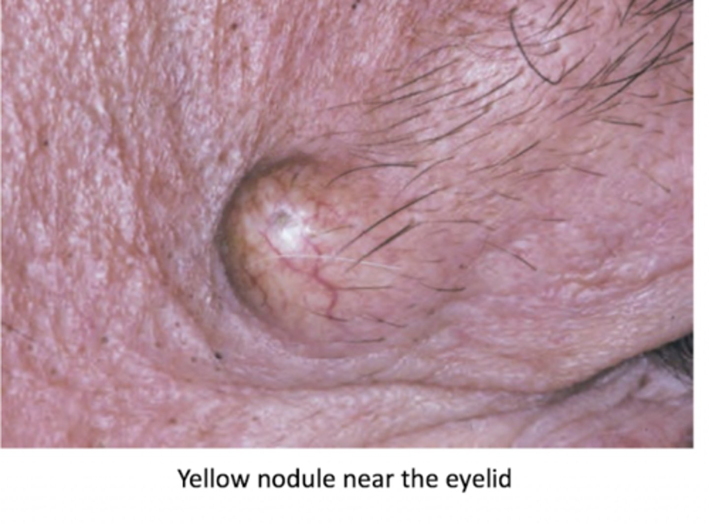 <p>head, neck, and back (acne-prone)</p>