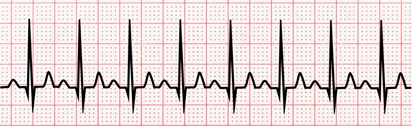 <p>name  ECG pattern</p>