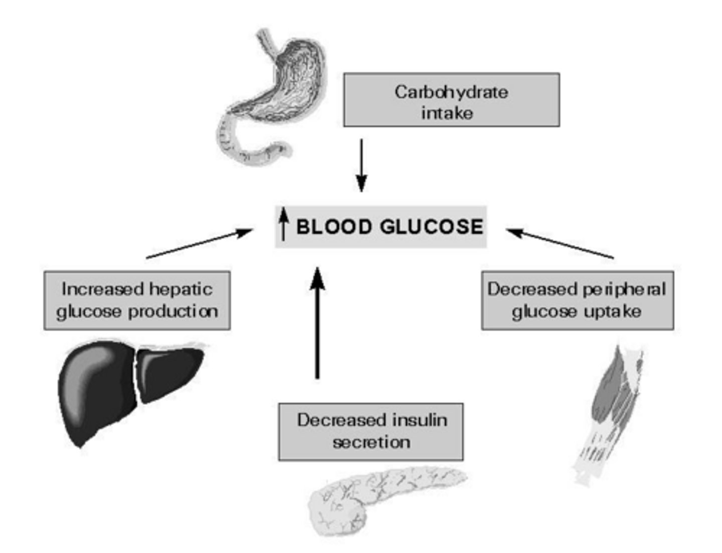 <p>A relative (not absolute) deficiency of endogenous insulin, combined with insulin resistance.</p>