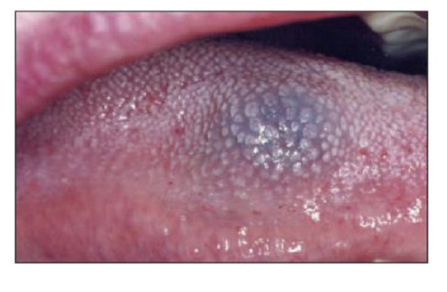 <p>A benign tumour of the vascular endothelium (blood vessels) - treated by cryosurgery</p>