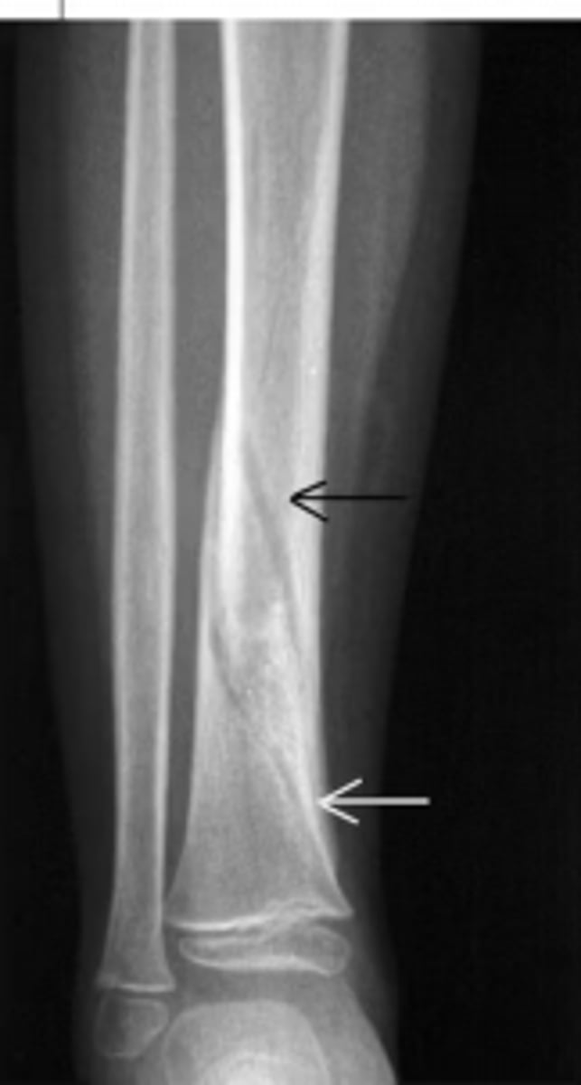 <p>Caused by high-energy direct force e.g., fall from height </p><p>+/- severe soft tissue injury and compartment syndrome</p><p>Can also be caused by low-energy trauma e.g., indirect twisting injury > spiral fracture pattern (image)</p>
