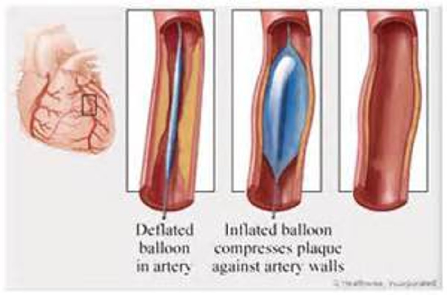 <p>-also known as balloon angioplasty (sx procedure)</p><p>-a catheter is inserted through femoral artery and guided to the coronary arteries</p><p>-balloon is inflated at lesion site to push plaque against arterial wall</p><p>-circulation improves after balloon deflates and catheter is removed</p><p>stent may be implanted to keep artery open</p>