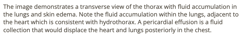 <p>b) pleural effusion</p>