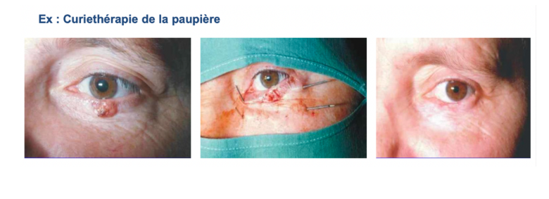 <p>Le radiothérapeute a positionné des fils métalliques d’iridium 192 dans la tumeur ce qui a permis d’irradier cette dernière</p><p>→Très bonne préservation de la paupière et une disparition complète de la tumeur</p>
