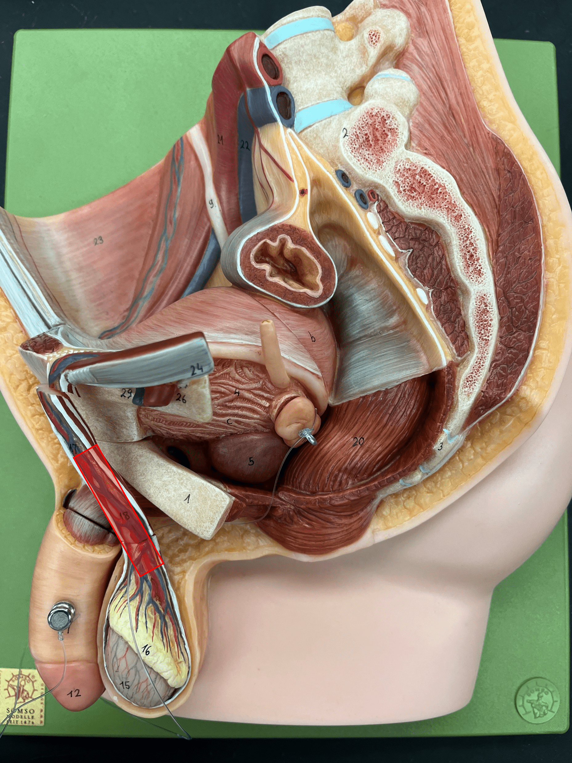 • A cord of tissue including blood vessels, nerves, and the ductus deferens.

• Attached to the tunica vaginalis.