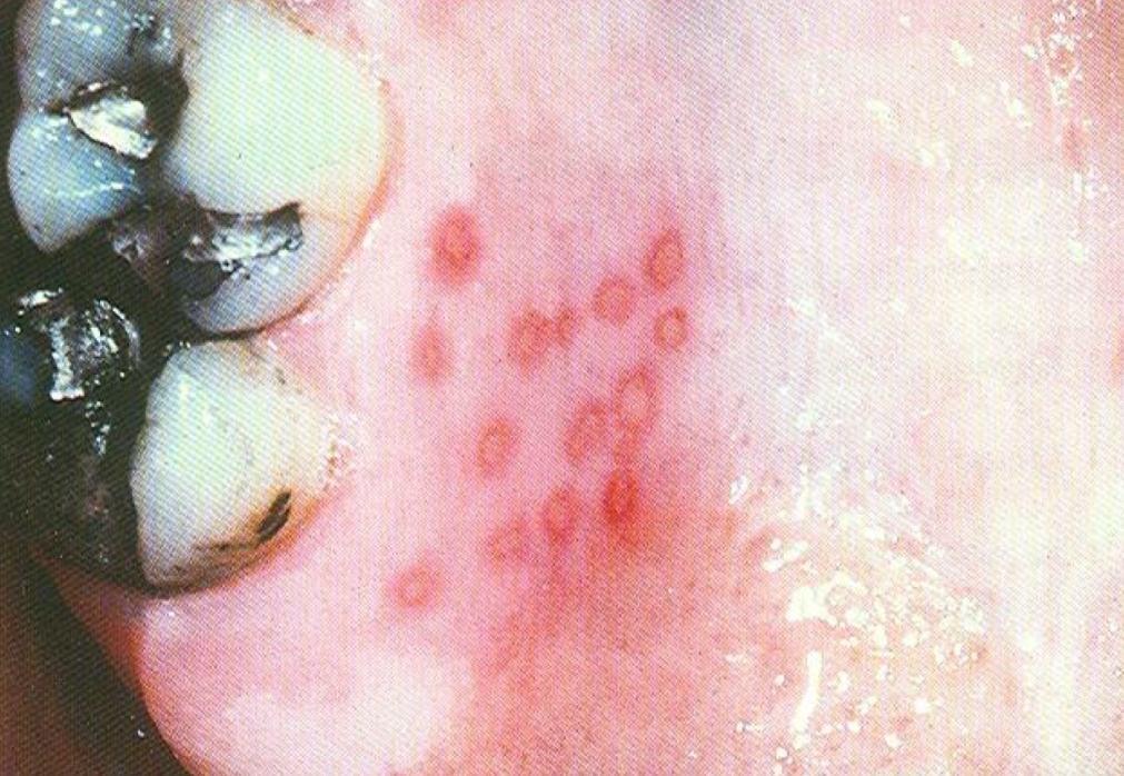 <p>Herpes simplex </p>