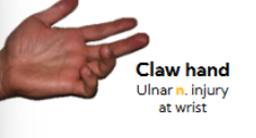 <p>ulnar nerve injury at wrist </p>
