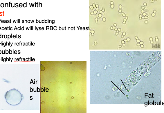 <ul><li><p class=""><strong>Yeast</strong>: Budding; <strong>resists acetic acid lysis</strong></p></li><li><p class=""><strong>Oil droplets</strong>: Highly <strong>refractile</strong>, variable in size</p></li><li><p class=""><strong>Air bubbles</strong>: <strong>Refractile</strong> and <strong>shiny</strong>; vary in size</p></li><li><p class=""><strong>Fat globules</strong>: Persist with acetic acid; ID via <strong>Sudan III</strong> or <strong>polarized light</strong></p></li></ul><p class=""></p><p class=""><strong>Confirmatory tip</strong>:<br>Add 1 drop of <strong>acetic acid</strong> to 1 drop of sediment — if RBCs <strong>disappear</strong>, blood was present. Yeast and fat will <strong>remain</strong>.</p><p class="">Ready for the next one when you are.</p>