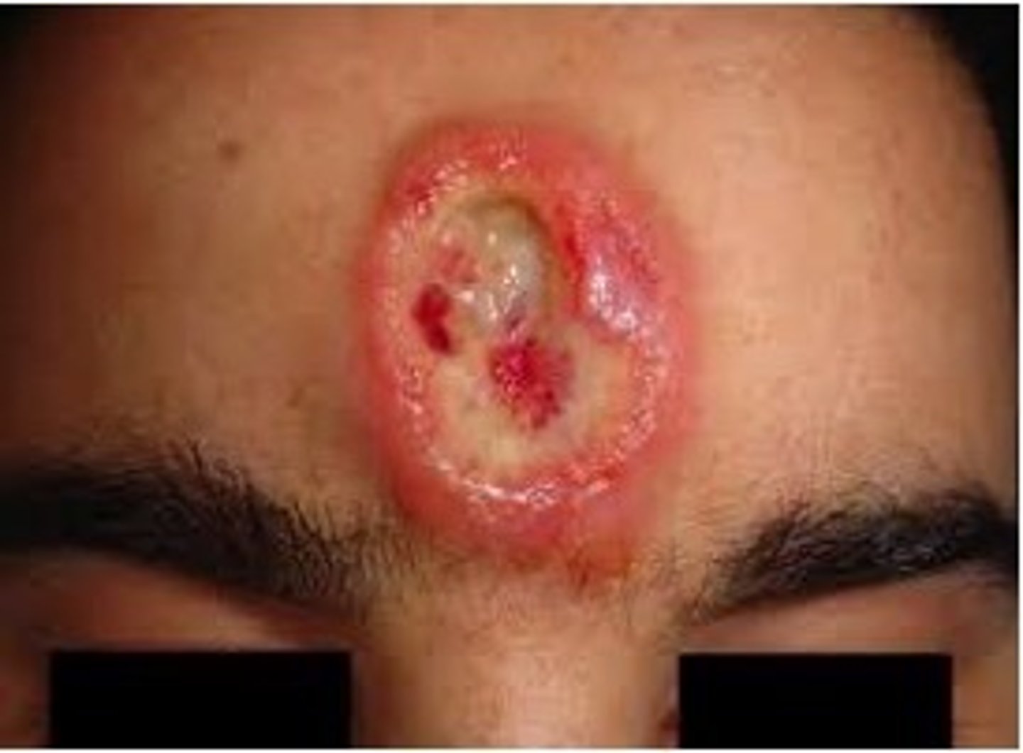 <p>1. benign (10-15 y): not affect vital organs but chronic phase includes "gummas"</p><p>2. cardiovascular (20-30 y): vascular inflammation. all pts &lt;45 should get tested</p>