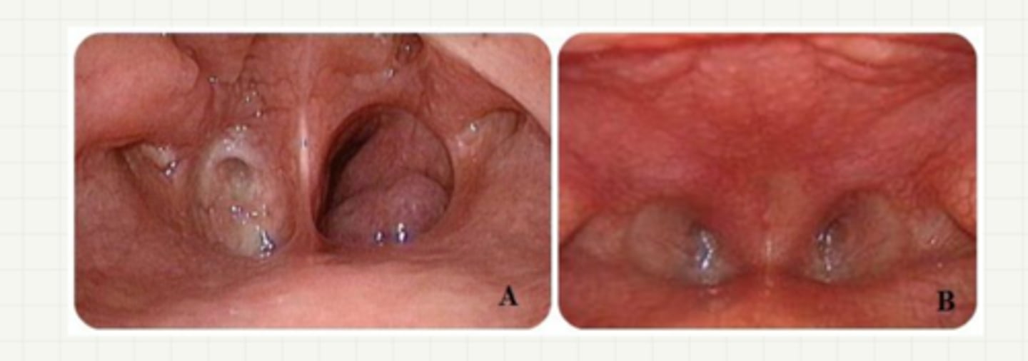 <p>choanal atresia sx</p>