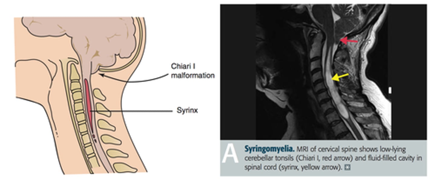 <p>Define Syrinx</p>