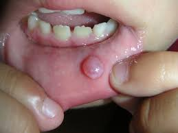 <p>mucous gets trapped in cell</p><p>cyst</p><p>surgically removed</p>