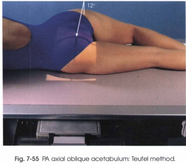 <p>pt lie recumbent in an anterior oblique position on the affected side</p>