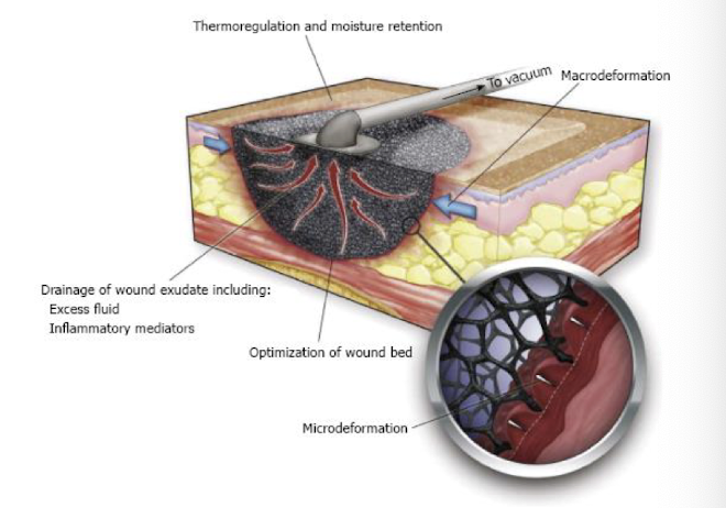 <p><strong>Negative pressure wound therapy (NPWT)</strong>; wound dressing systems that continuously or intermittently apply sub-atmospheric pressure to the system, which <strong>provides a positive pressure to the surface of a wound</strong></p><p><em>Indications</em>:<br><strong>• Dehisced surgical wounds <br>• Complex operative wounds</strong> left open<strong> </strong>to heal by <strong>secondary</strong> <strong>intention</strong> <br>• Diabetic ulcers <br>• Chronic wounds <br>• Acute wounds <br>• Pressure ulcers <br>• Flaps and grafts <br>• Chronic or acute enteric fistulas</p><p>-<strong>Uninfected</strong> wound: change dressings <strong>q24-48 hours</strong><br>-<strong>Infected</strong> wound: changes dressings <strong>q12-24 hours</strong><br>-<strong>Do not stop or remove suction for &gt;2 hours</strong></p><p><strong>-</strong><span style="color: green"><strong>Discontinue</strong></span> with adequate granulation that allows change to conventional dressing, split thickness graft or flap closure<br>-<em>also d/c with extreme pain, excessive bleeding, alternative treatment, local or spreading infection </em></p>