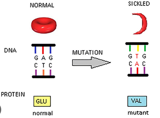 <ol><li><p>a mutation in a single base occurs, GAG → GTG</p><ol><li><p>this is called an SNP (single nucleotide polymorphism)</p></li></ol></li><li><p>this causes a change in mRNA sequence when  the DNA is copied during transcription</p></li><li><p>when the normal mRNA is translated, it produces <mark data-color="green">glutamic acid</mark></p></li><li><p>but when the mutated mRNA is translated, it produces <mark data-color="red">valine</mark> instead</p></li><li><p>valine has a different shape and charge (compared to glutamic acid), so it causes the entire polypeptide chain’s shape and structure to change</p></li><li><p>therefor the shape of hemoglobin changes</p></li><li><p>and then the shape of the whole red blood cell changes to a half-moon shape (sickle shape)</p></li></ol>
