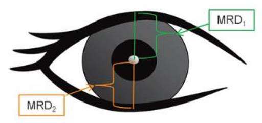 <p>Ectropion testing:</p><ul><li><p>MRD 1 + MRD 2 = ____ </p><ul><li><p>M: 7-10mm</p></li><li><p>F: 8-12mm</p></li></ul></li></ul><p></p>