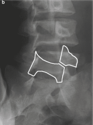 <p>spondylolysis</p><p>unilateral pars interarticularis fracture</p><p>disc has not moved</p>
