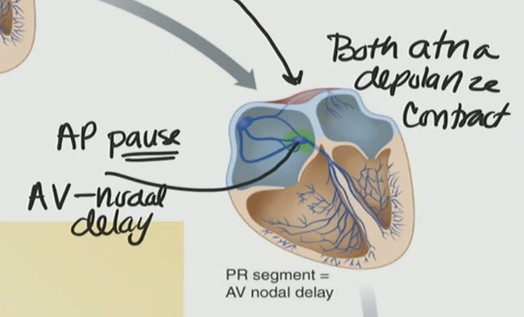 <p>D. AV node → AV nodal delay</p>