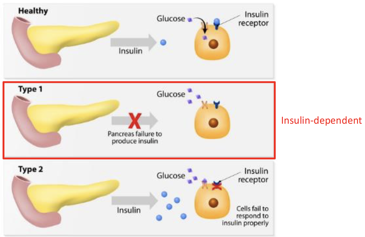 <p>Autoimmune disease - destruction of pancreatic B-cells, failure to produce insulin</p>