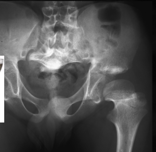 <p>what is seen here for this case of achondroplasia?</p>