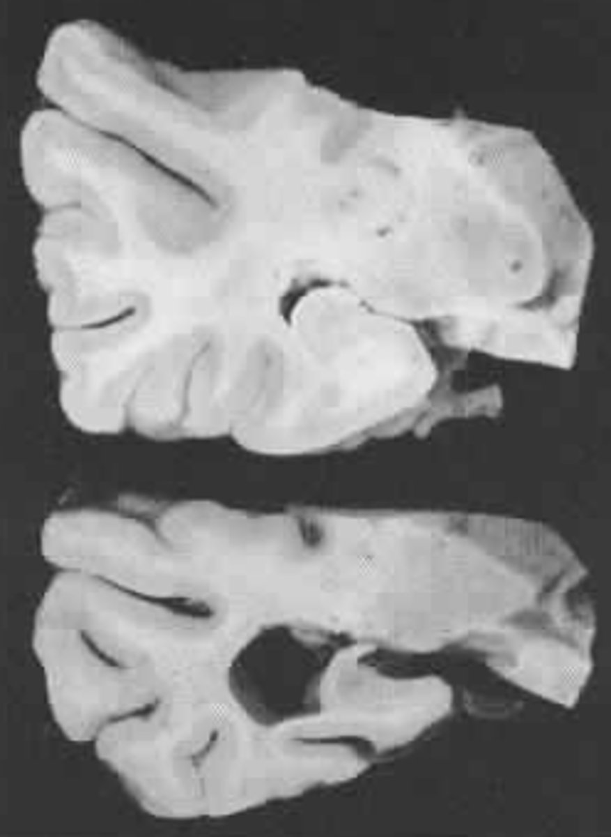 <p>- Immediate recall</p><p>- Attention to selected information</p><p>- Recent events</p><p>- Relationships (view their relatives as strangers)</p>