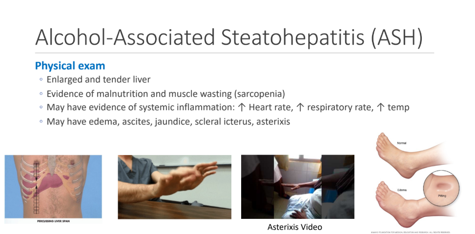 <ol><li><p>Enlarged and tender liver</p></li><li><p>Evidence of malnutrition and muscle wasting (sarcopenia)</p></li><li><p> May have evidence of systemic inflammation: ↑ Heart rate, ↑ respiratory rate, ↑ temp</p></li><li><p> May have edema, ascites, jaundice, scleral icterus, <strong>asterixis</strong></p></li></ol><p></p>