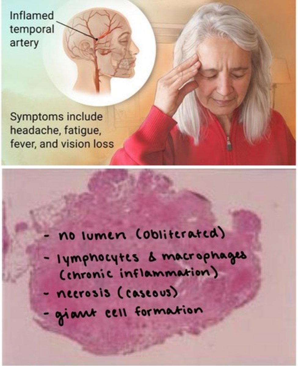 <p>aka <strong>Temporal arteritis.</strong></p><p></p><p><span class="bgP">most common form of systemic inflammatory vasculitis in adults/</span><strong><span class="bgP">elderly.</span></strong></p><p></p><p>inflammation of medium and large sized blood vessels</p><p></p><p><span style="text-decoration:underline">Prodrome Sx</span>: HA, fatigue, fever, sudden blurry vision</p>