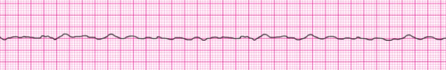 <p>Following initiation of CPR and 1 shock for VF, this rhythm is present on the next rhythm check. A second shock is given and chest compressions are resumed immediately. An IV is in place and no drugs have been given. Bag-mask ventilations are producing visible chest rise. What is your next order?</p><p>1. Administer 3 sequential (stacked) shocks at 360 J (monophasic defibrillator).</p><p>2. Prepare to give amiodarone 300 mg IV.</p><p>3. Administer 3 sequential (stacked) shocks at 200 J (biphasic defibrillator).</p><p>4. Perform endotracheal intubation; administer 100% oxygen.</p><p>5. Prepare to give epinephrine 1 mg IV.</p>