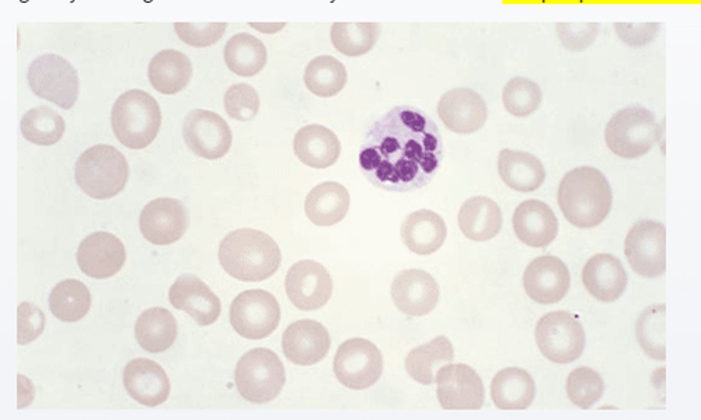<p>-peripheral blood smear show large red blood cells and hypersegmented neutrophil</p><p>-Both folate and cobalamin are invovled in the conversion of Homo-cysteine to methionine</p>