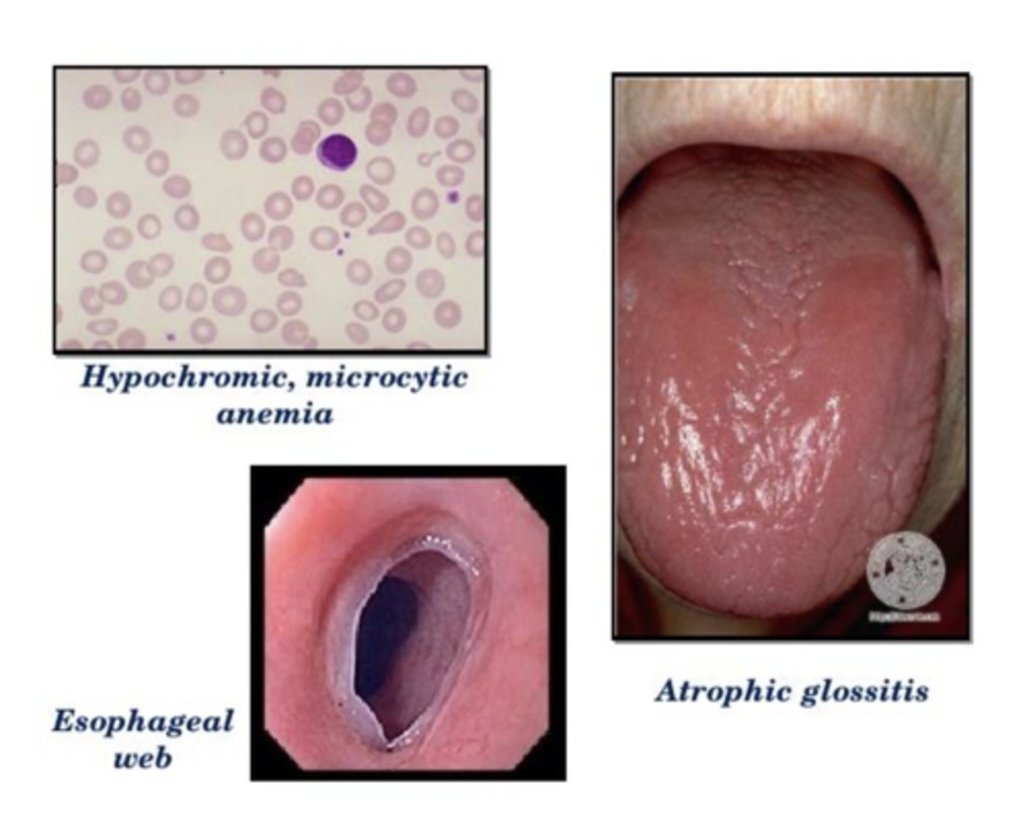 <p>Define Condition:</p><p>-Hx:</p><p>&gt; Rare</p><p>&gt; MC in Women</p><p>&gt; A/w Glossitis (inflamed tongue)</p><p>-Path: Lack of iron to act as co-factors to enzymes specific to the esophagus affects epithelial turnover and leads to webs​</p><p>-Sx/PE: NON-PROGRESSIVE Dysphagia + IDA + Esophageal Webs (thin mucosal membrane that grows across the lumen &amp; found in proximal esophagus)</p><p>-Dx: Barium Swallow</p><p>-Tx:</p><p>&gt; Correct IDA</p><p>&gt; Dilatation of Web (relieve dysphagia)</p><p>-Prog: Risk of SCC of Pharynx and Esophagus</p>