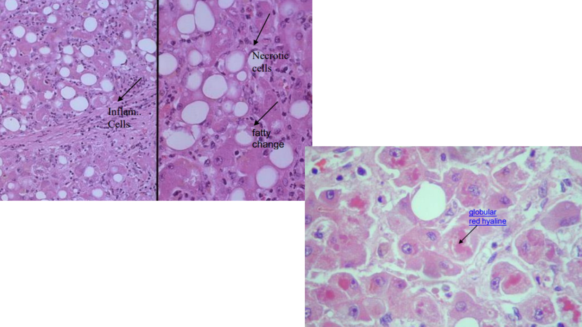 <p>Alcoholic Hepatitis/Fatty Liver Disease</p>