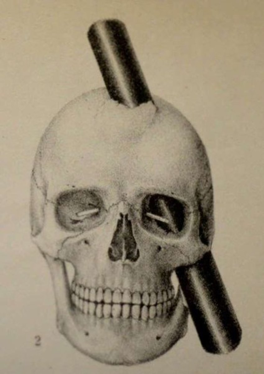 <p>Severing frontal lobes to calm severe disorders.</p>