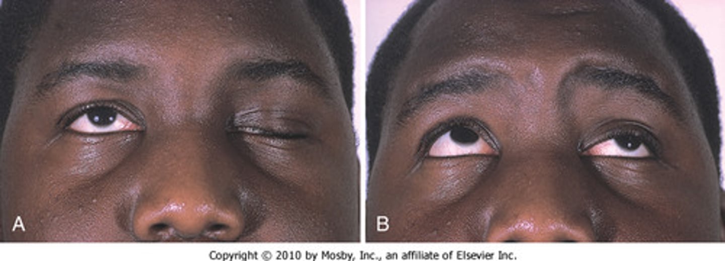 <p>a chronic autoimmune disorder in which antibodies destroy the communication between nerves and muscle, resulting in weakness of the skeletal muscles</p>