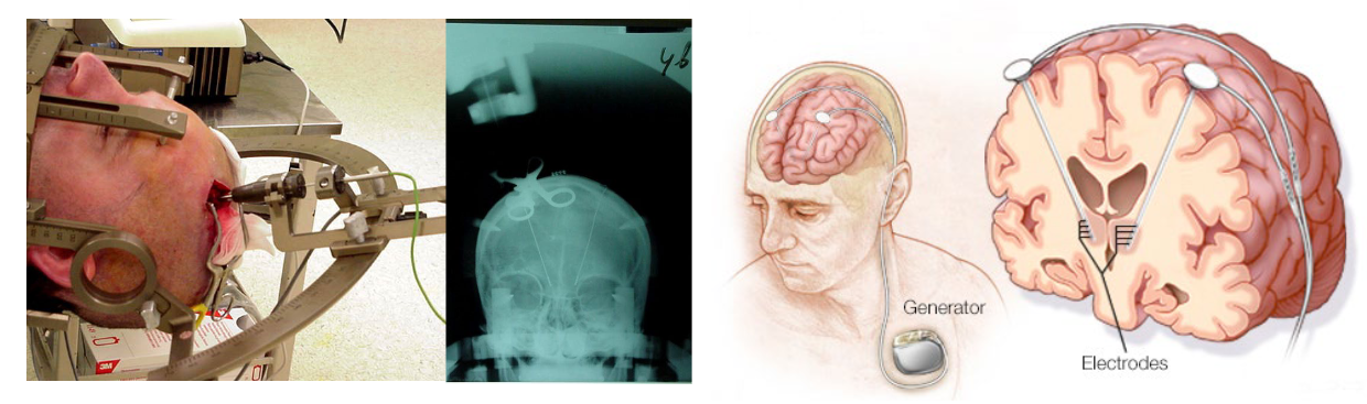 <p>A device for Manipulating brain-behavior interactions which allows targeting of a specific part of the brain → fixates brain.</p><ul><li><p>Psychosurgery (ablation, lesions, gamma “knife” radiation).</p></li><li><p>Deep brain stimulation (Parkinson’s disease).</p></li></ul><p></p>