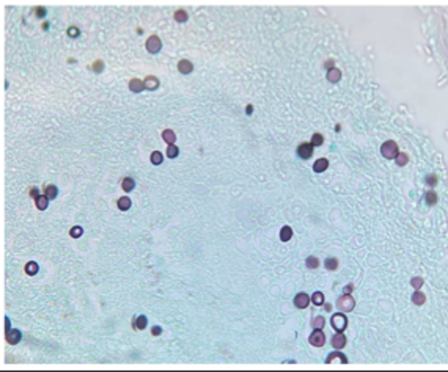 <p>A dog with cough and draining skin lesions undergoes radiographs showing nodular lung disease. Lung aspirates show large (8–15 µm) thick-walled yeast with broad-based budding.</p>