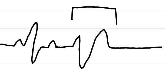 <ul><li><p>rate: variable</p></li><li><p>rhythm: <span style="color: red;">regular until interrupted</span></p></li><li><p>P waves: <span style="color: red;">not associated</span></p></li><li><p>PR interval: <span style="color: red;">not measurable</span></p></li><li><p>QRS complexes: <span style="color: red;">>0.12 sec, premature, abnormal, followed by compensatory pause</span></p></li><li><p>ST segments: <span style="color: red;">not seen after abnormal QRS</span></p></li><li><p>subtypes: unifocal, multifocal, couplets, R-on-T</p></li></ul><p></p>